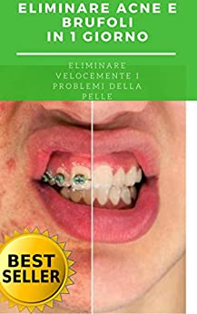 Eliminare l’acne e i brufoli in un giorno: Eliminare velocemente i problemi della pelle